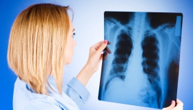 На туберкульоз на Полтавщині хворіють у середньому 30 людей зі 100 тисяч