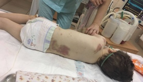 На Полтавщині медики борються за життя чотирирічного хлопчика, побитого до напівсмерті вітчимом