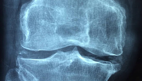 Чим можна зняти біль при артриті?