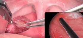 Ціна на видалення мигдаликів: що впливає на вартість операції