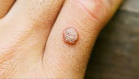 Вірусні бородавки: що це таке, чому з&rsquo;являються і чому важливо лікувати ВПЛ, а не лише прибирати наріст