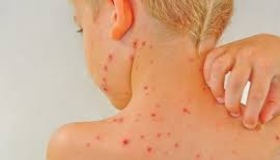 На Полтавщині зросла кількість хворих на вітряну віспу