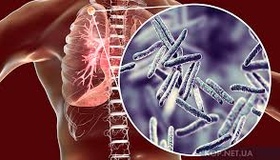 На Полтавщині значно зменшилася захворюваність на туберкульоз