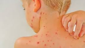 На Полтавщині побільшало випадків вітрянки